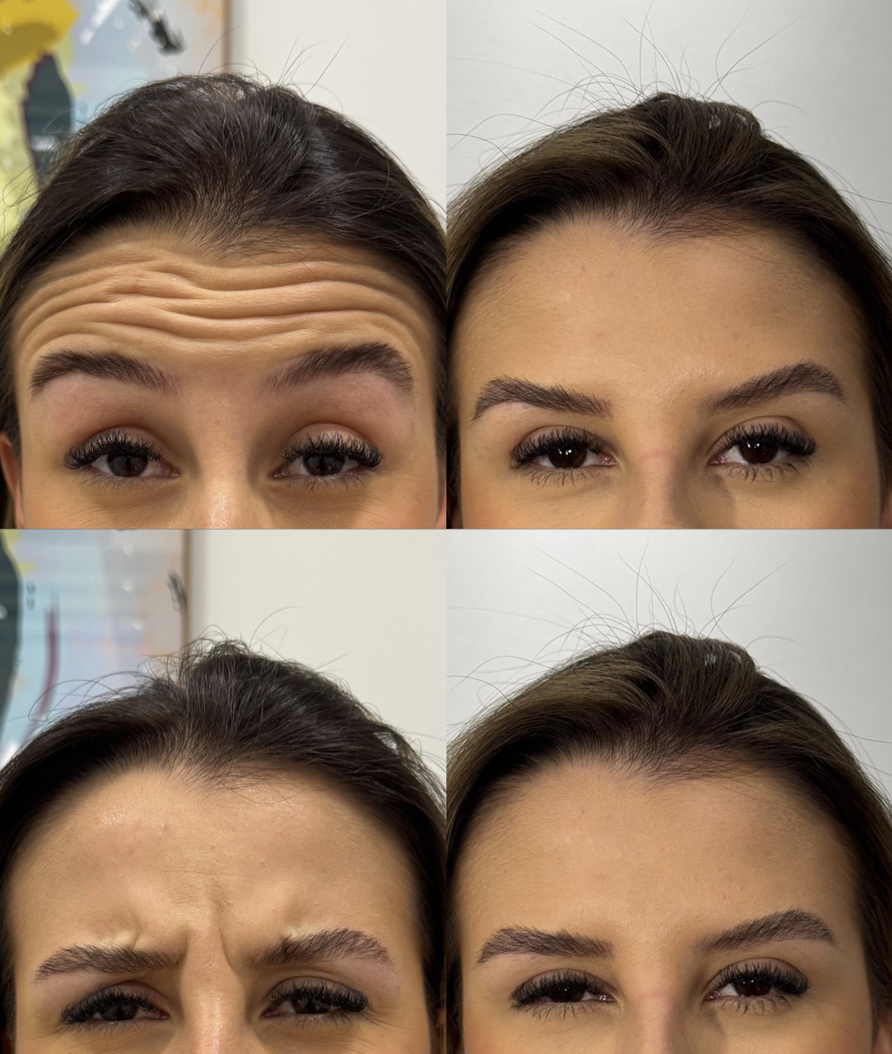 Resultado antes e depois na região frontal