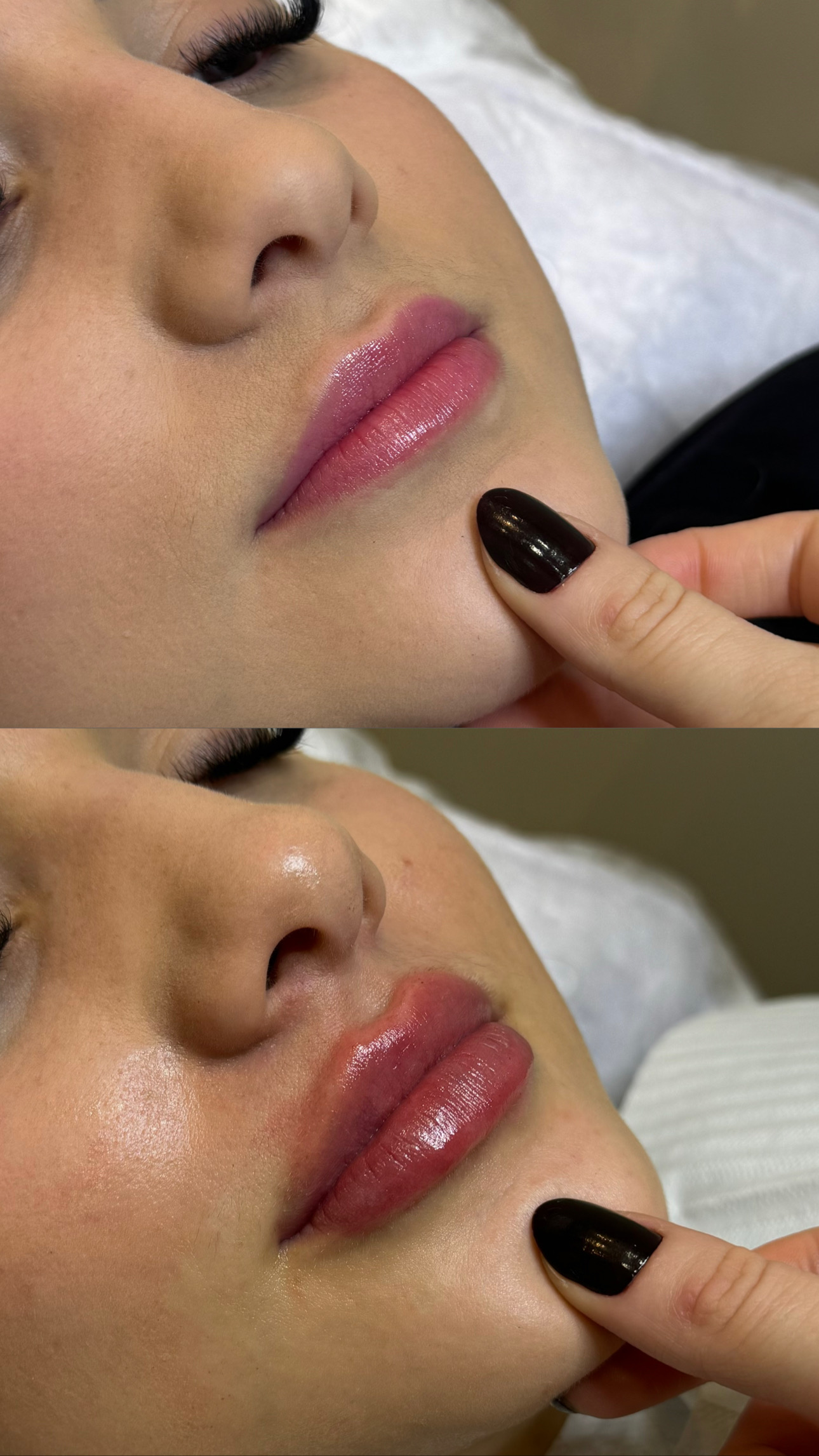 Resultado antes e depois com harmonização de lábios e perfil