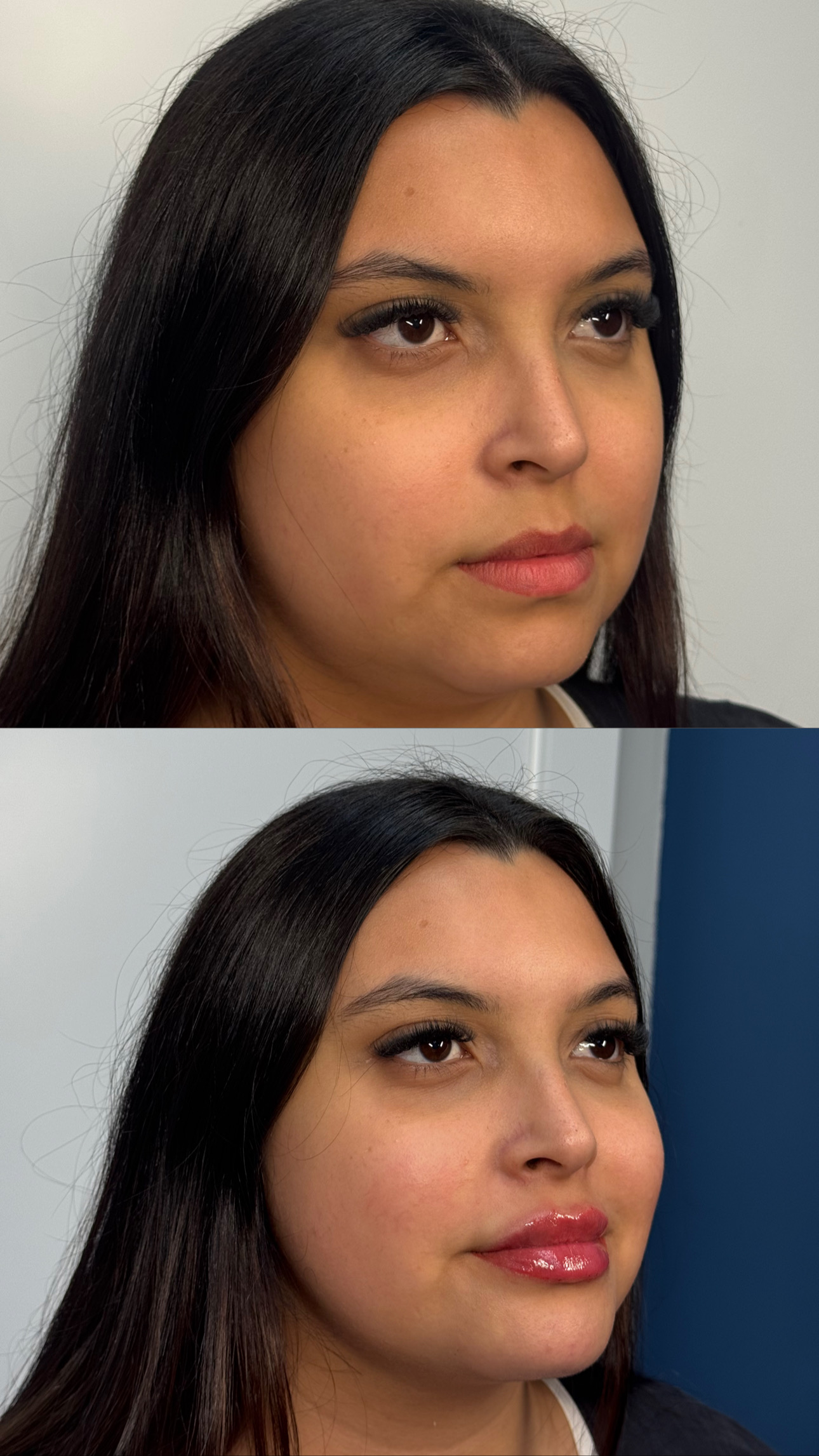 Resultado antes e depois com valorização de contorno facial