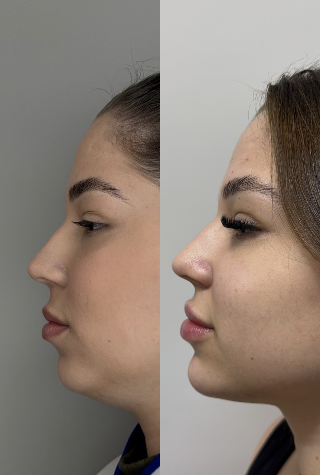 Resultado antes e depois com definição de perfil