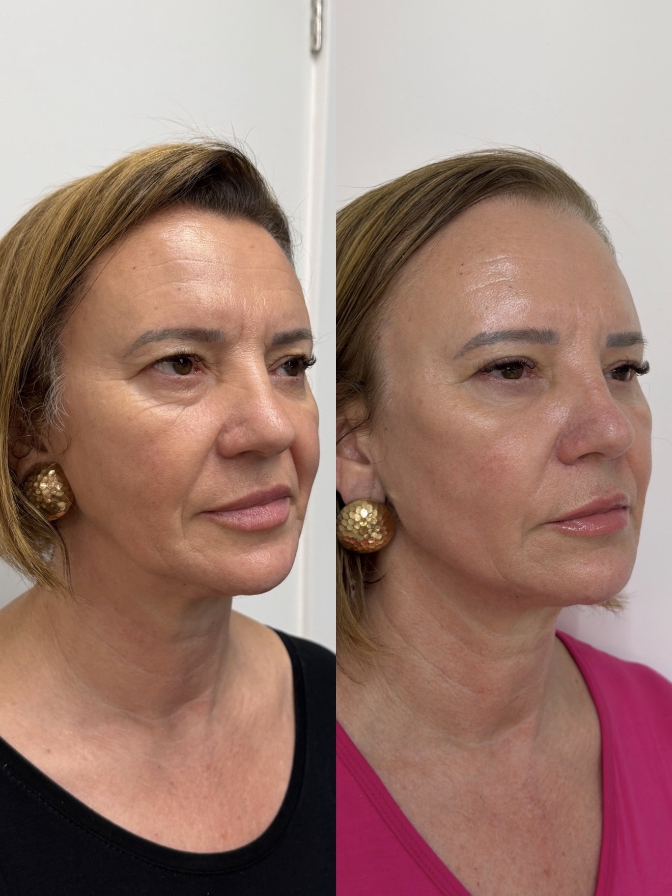Resultado antes e depois com harmonização facial