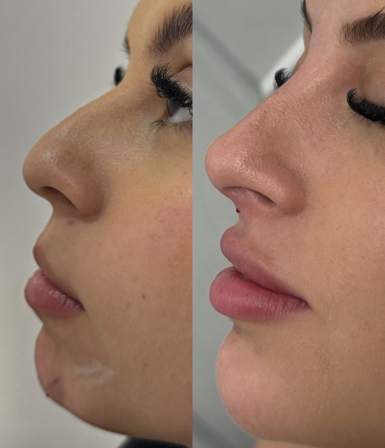 Resultado antes e depois de perfil facial